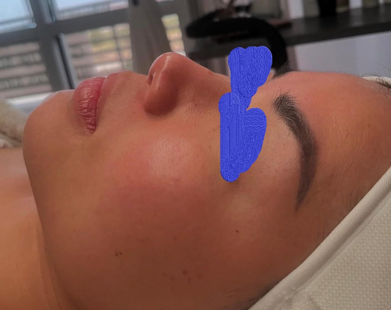 Client skin before facial treatment at Lumiderm Jacksonville FL