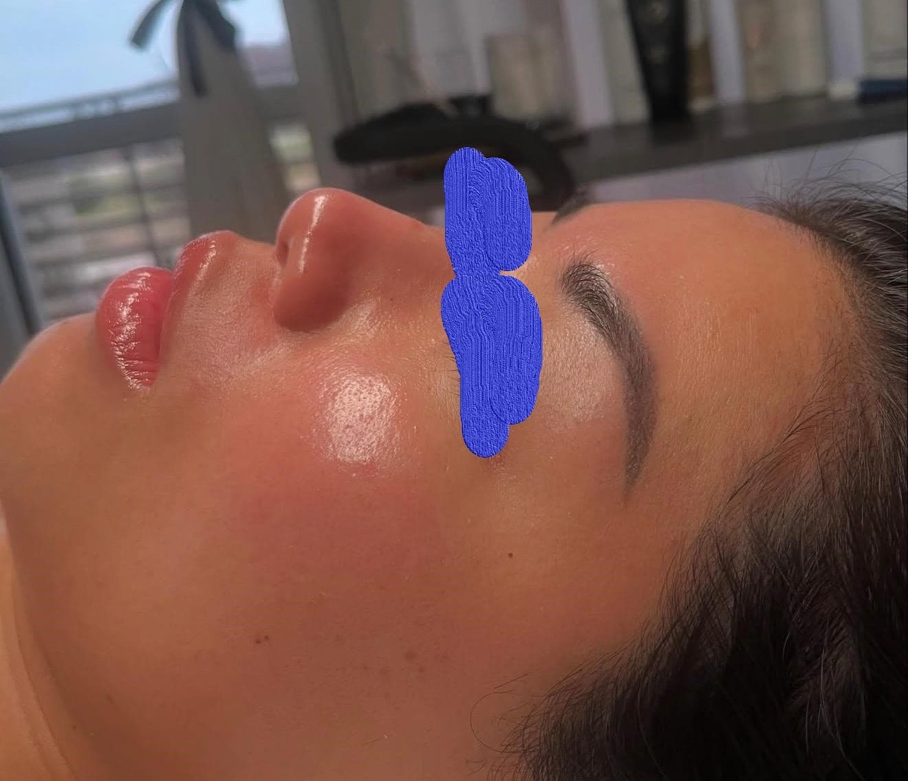 Client skin after facial treatment at Lumiderm Jacksonville FL — improved texture and clarity