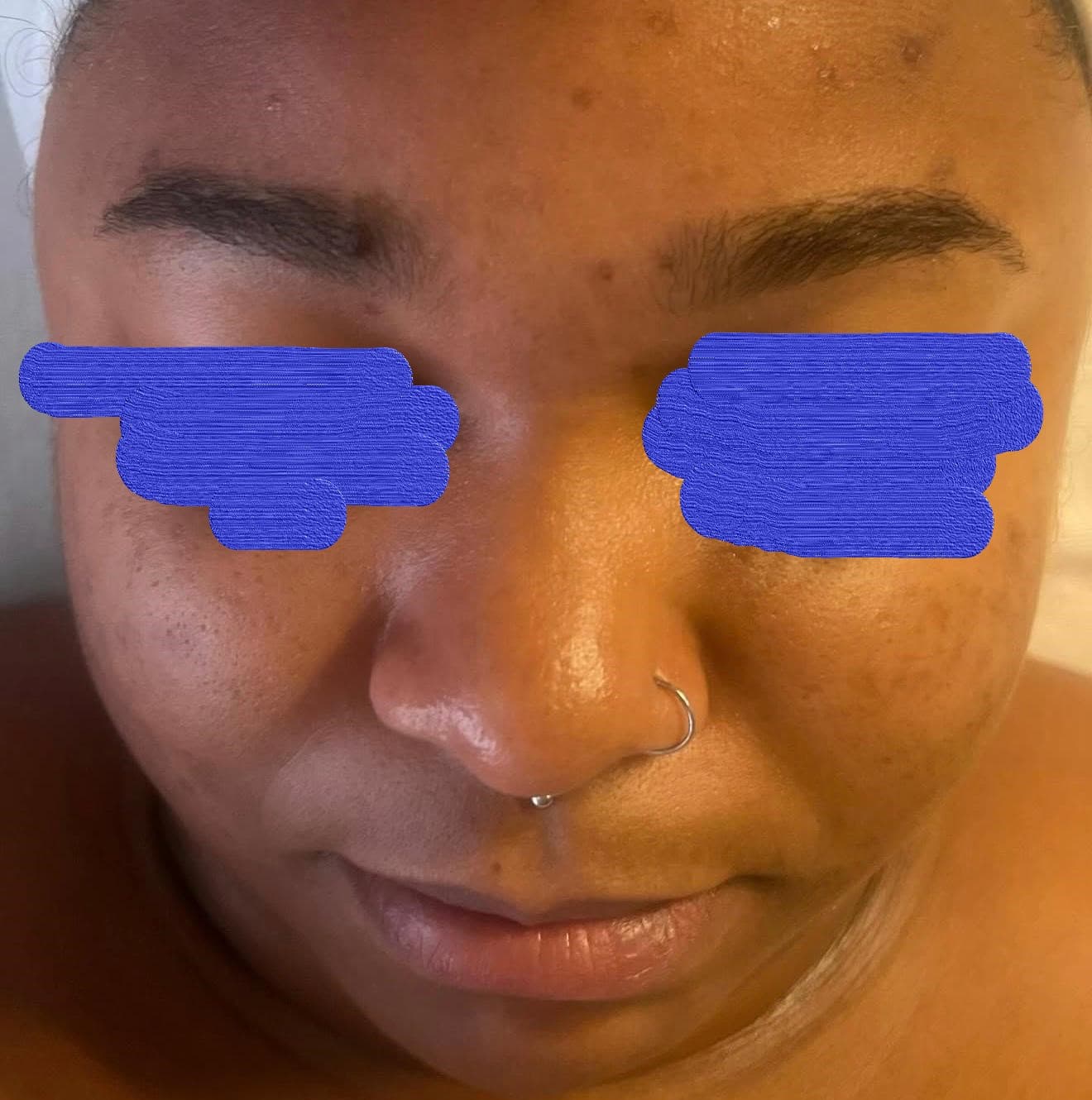 Client skin before brightening facial at Lumiderm Jacksonville FL