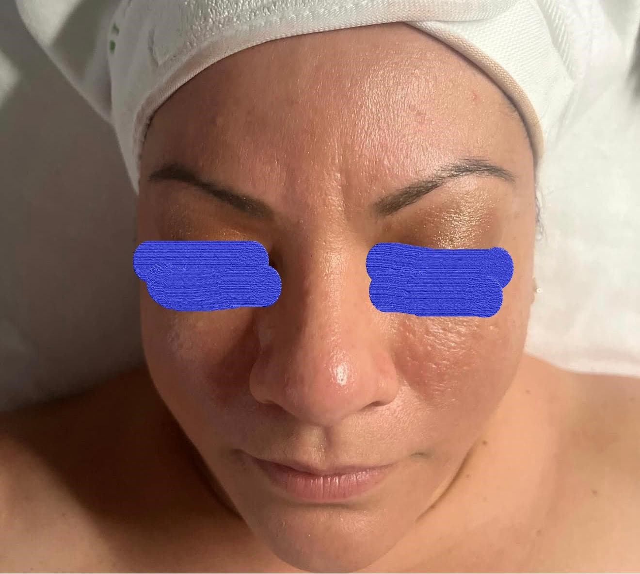 Client skin before chemical peel at Lumiderm Jacksonville FL