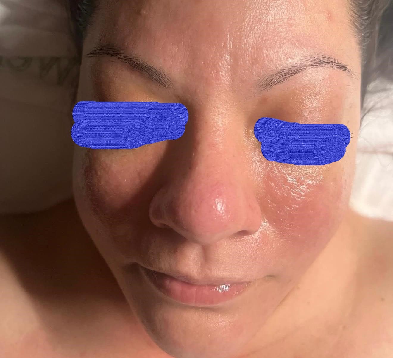 Client skin after chemical peel — smoother texture and clearer complexion