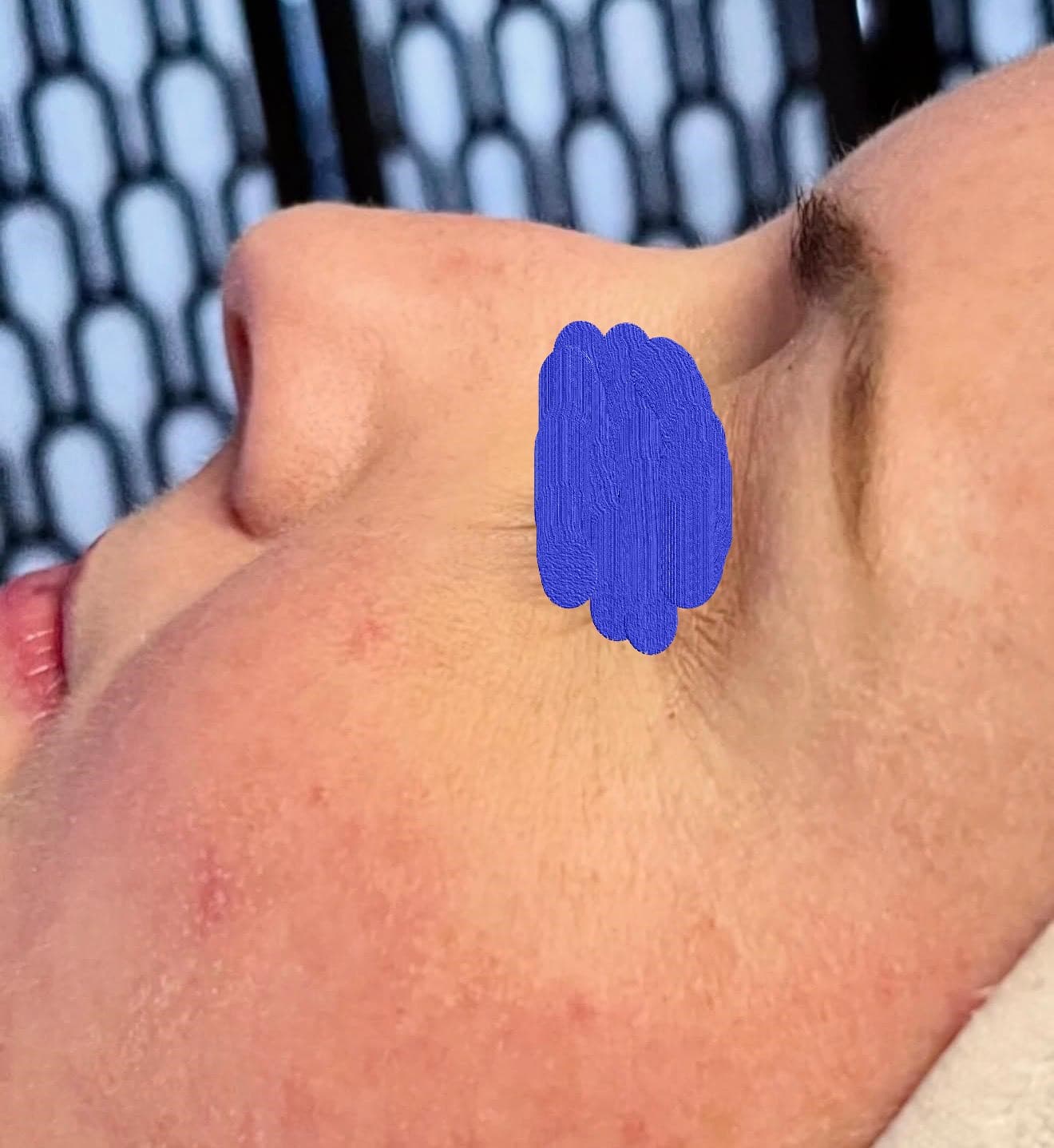 Client skin before anti-aging facial at Lumiderm Jacksonville FL