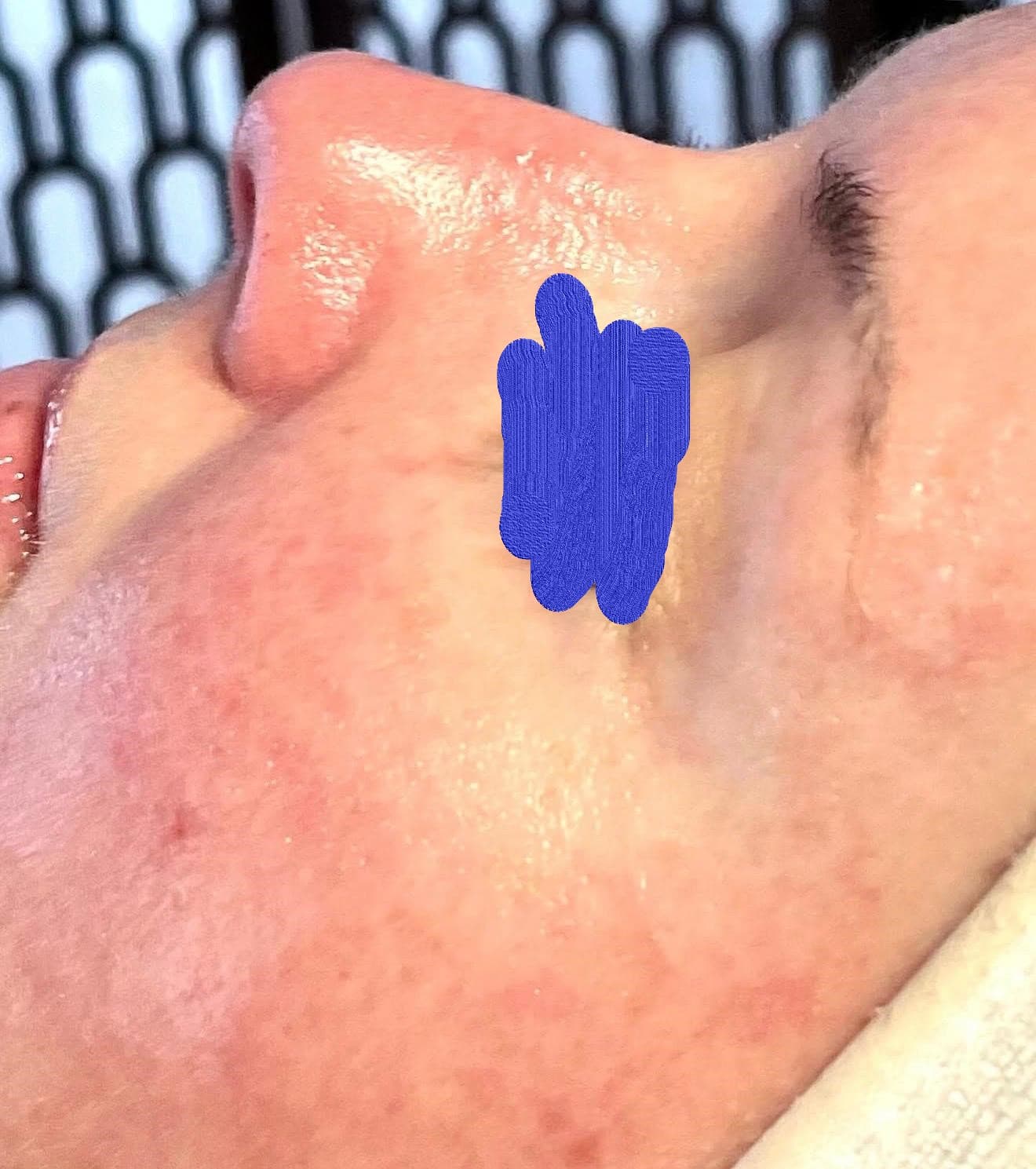 Client skin after anti-aging facial — firmer, more radiant skin