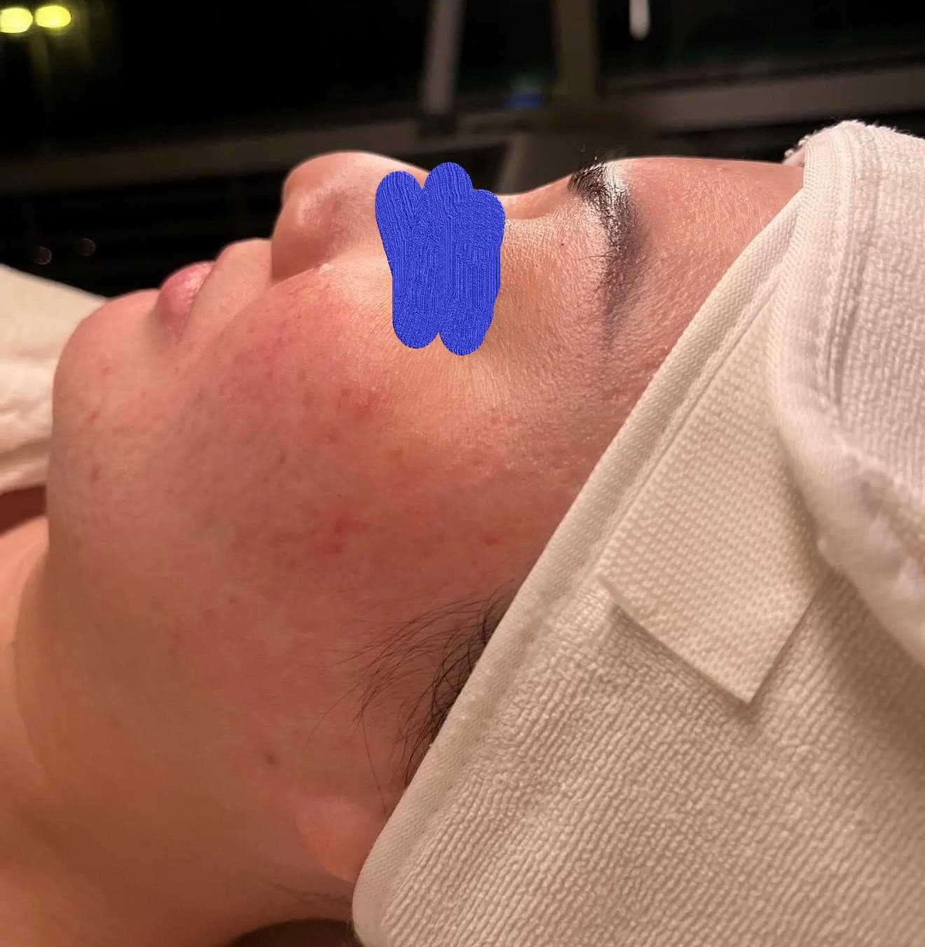 Client skin before professional skincare treatment at Lumiderm Jacksonville FL