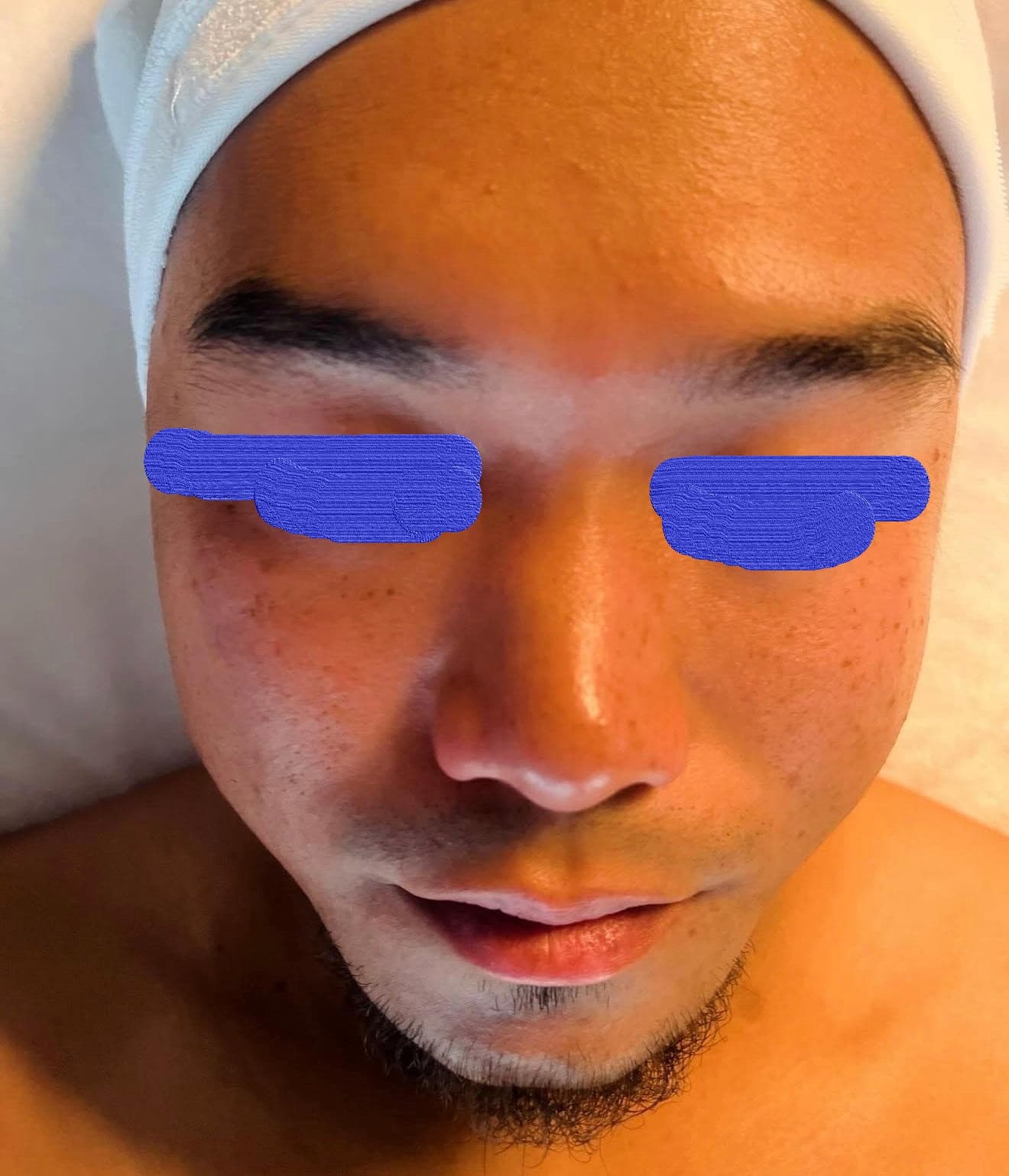 Client skin before acne facial treatment at Lumiderm Jacksonville FL