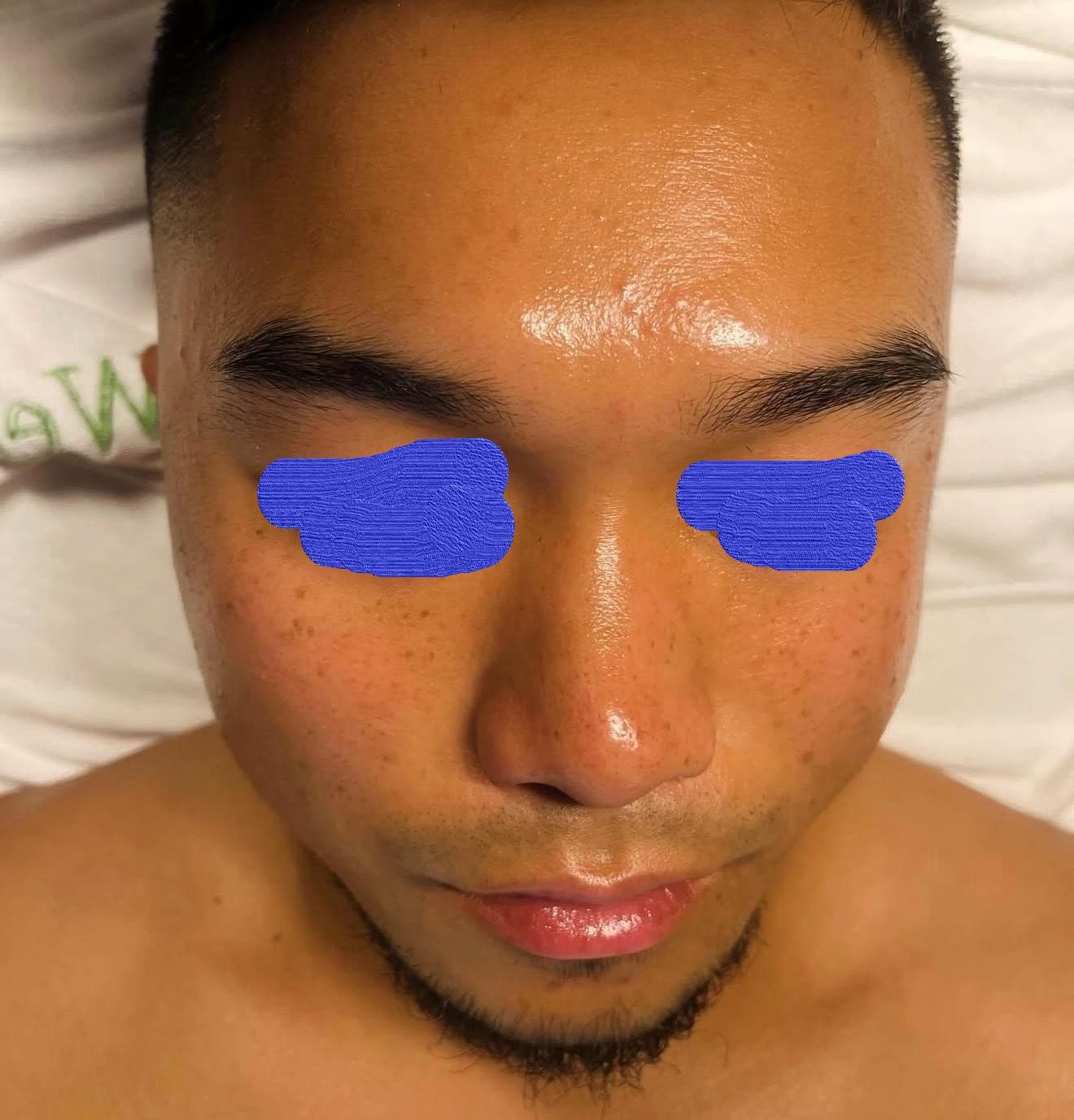 Client skin after acne facial treatment — reduced breakouts and clearer skin