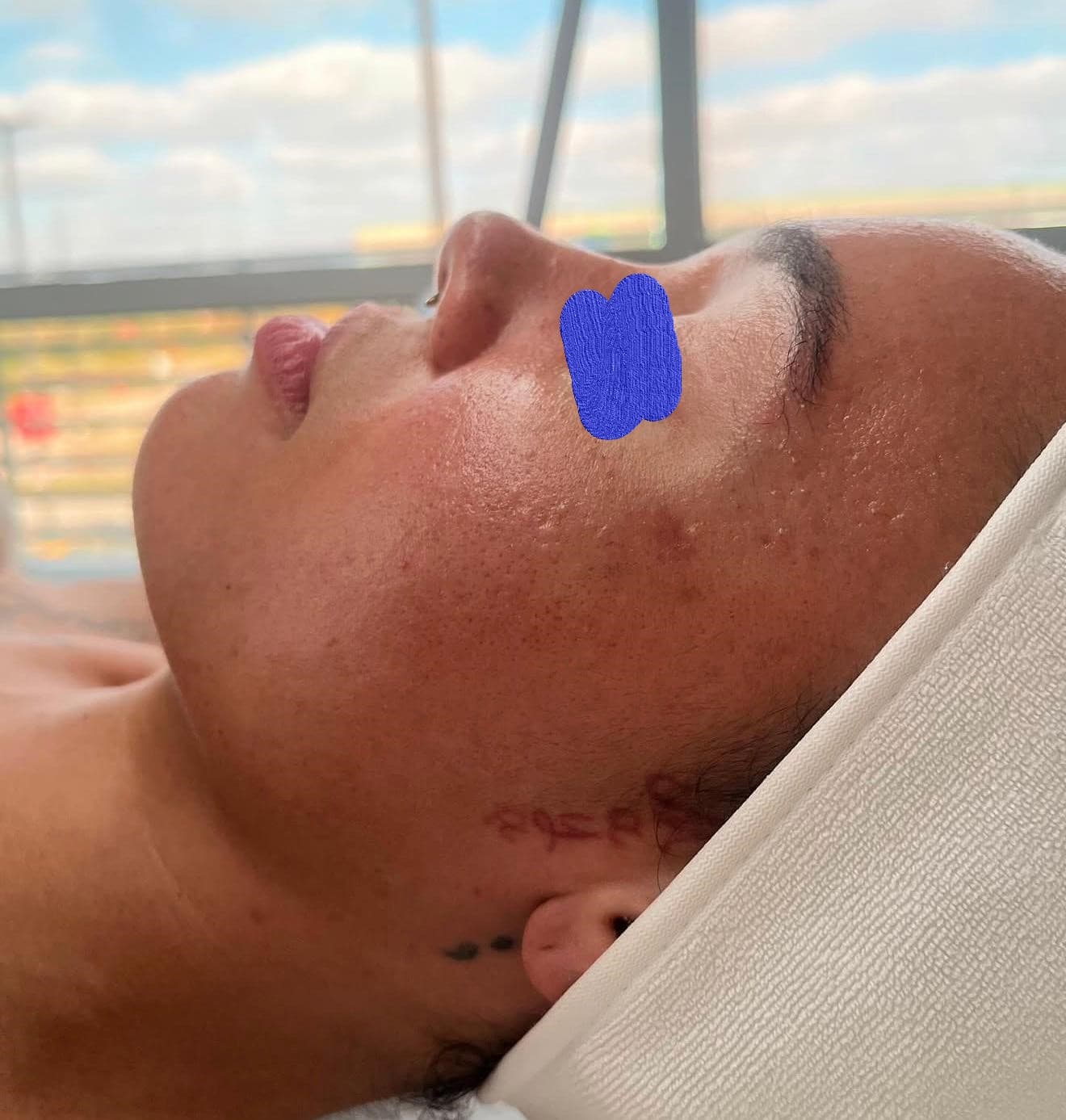 Client skin before dermaplaning at Lumiderm Jacksonville FL
