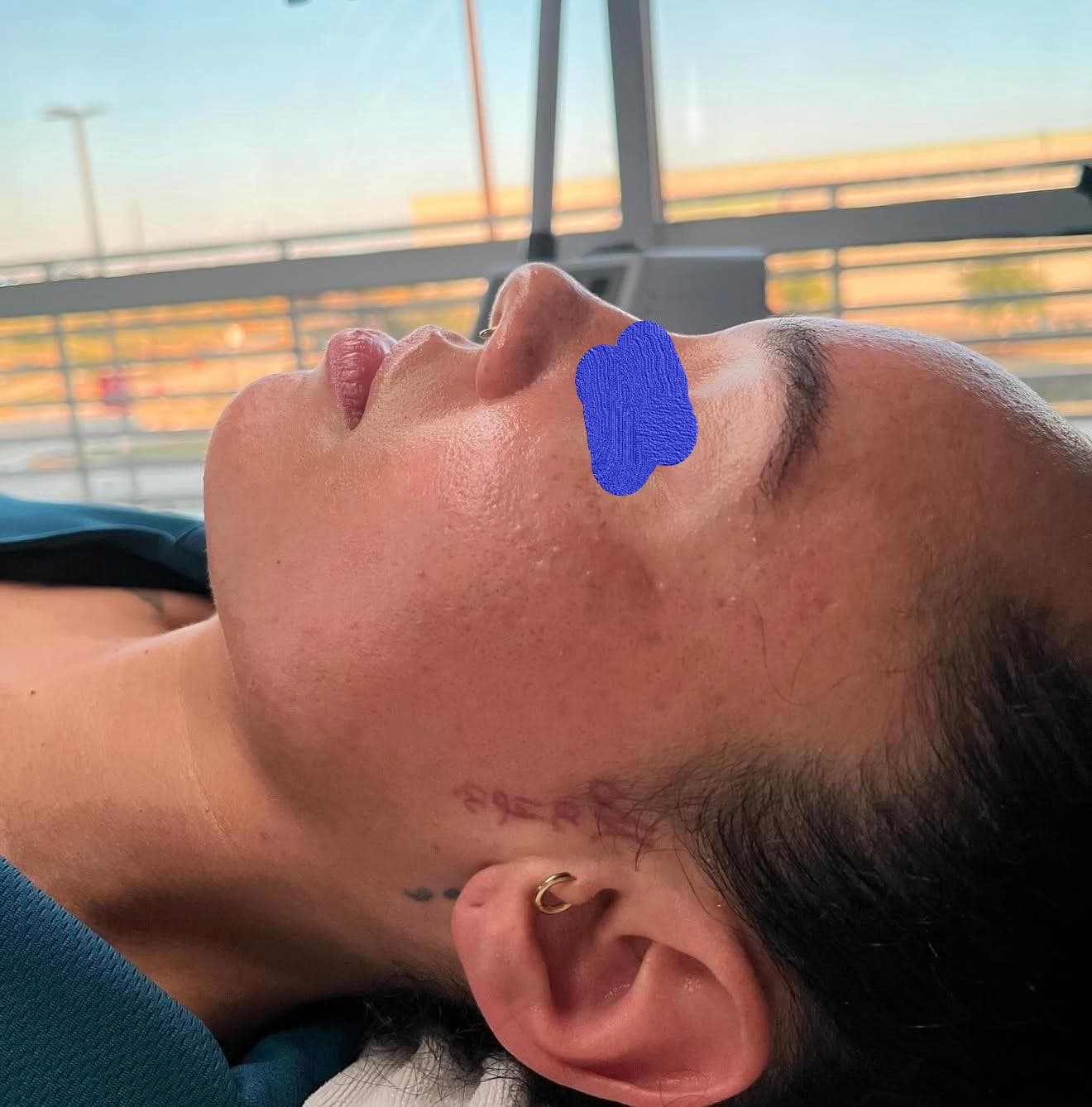 Client skin after dermaplaning — smoother surface and brighter appearance