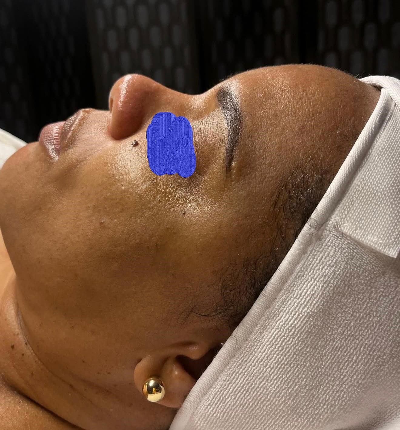 Client skin before hydrating facial at Lumiderm Jacksonville FL