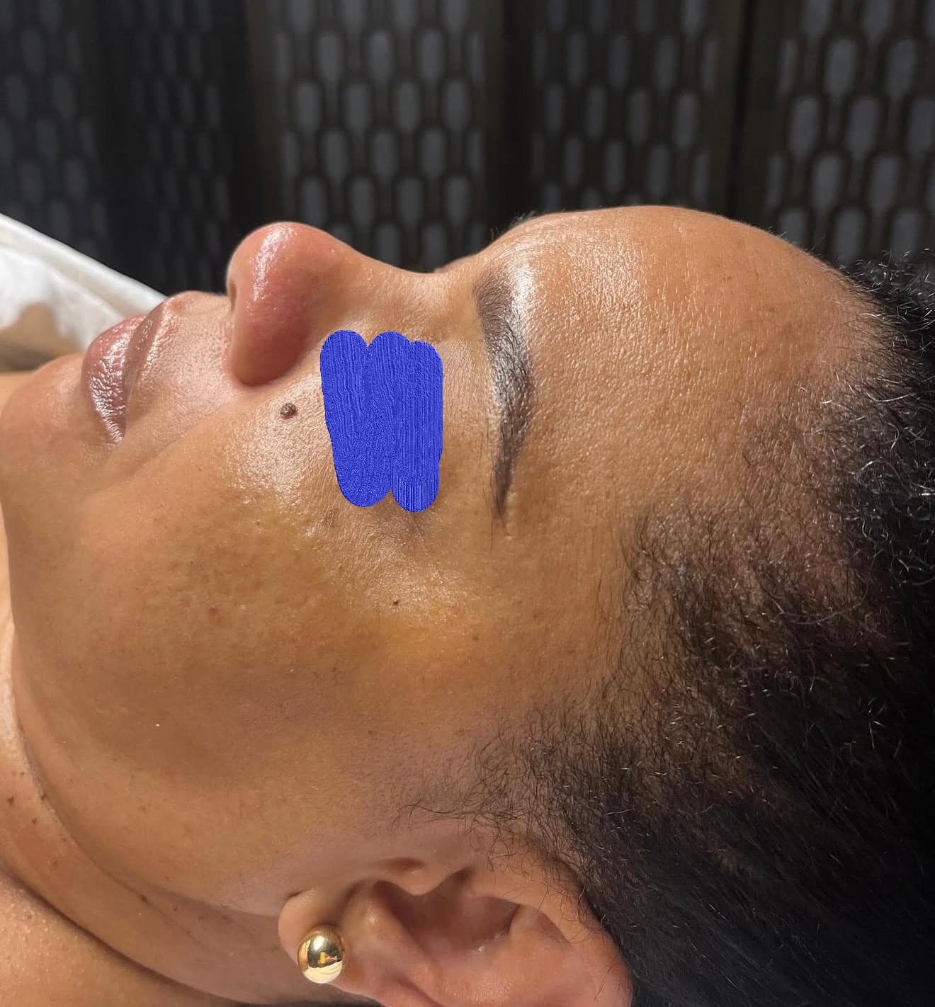 Client skin after hydrating facial — plumper, more moisturised complexion