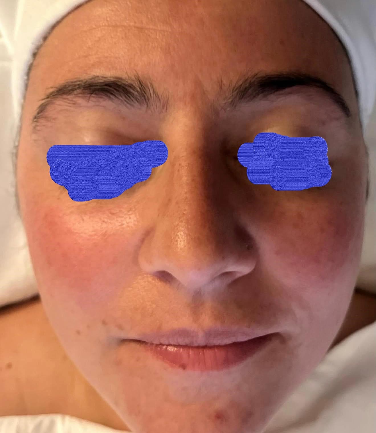 Client skin before skin tightening treatment at Lumiderm Jacksonville FL