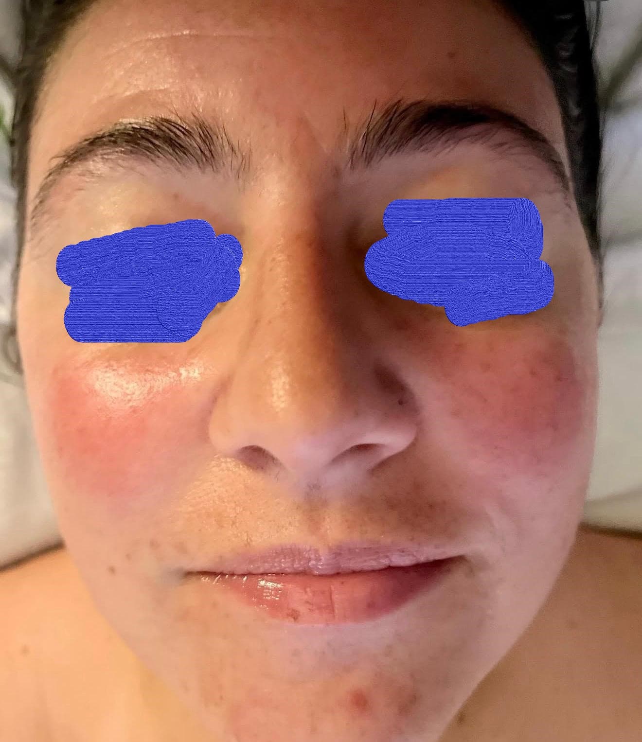 Client skin after skin tightening treatment — firmer and more lifted appearance