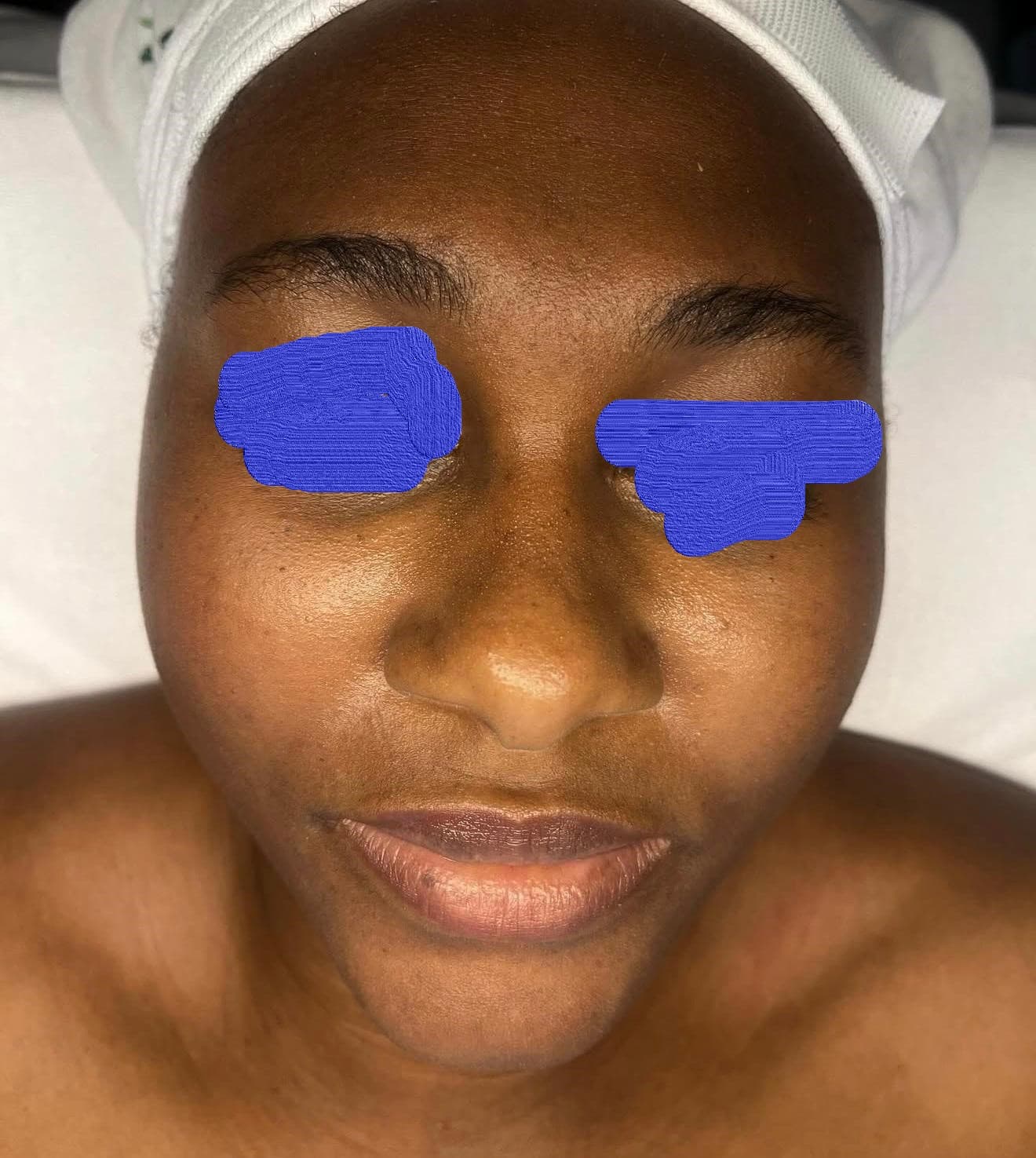 Client skin before LED photofacial at Lumiderm Jacksonville FL