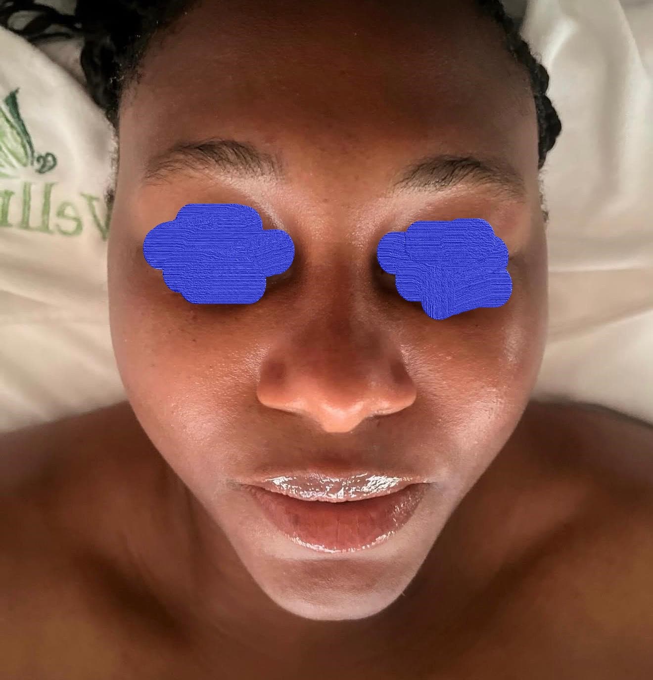 Client skin after LED photofacial — reduced redness and improved skin health