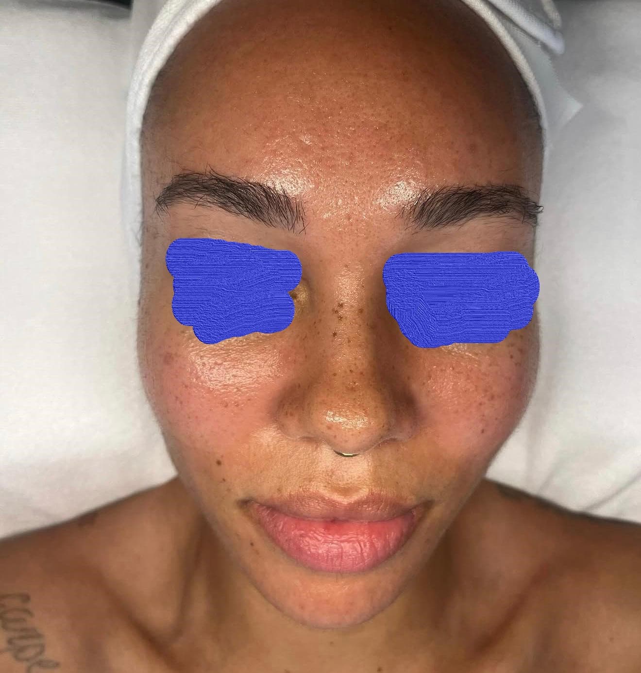 Client skin before deep cleansing facial at Lumiderm Jacksonville FL