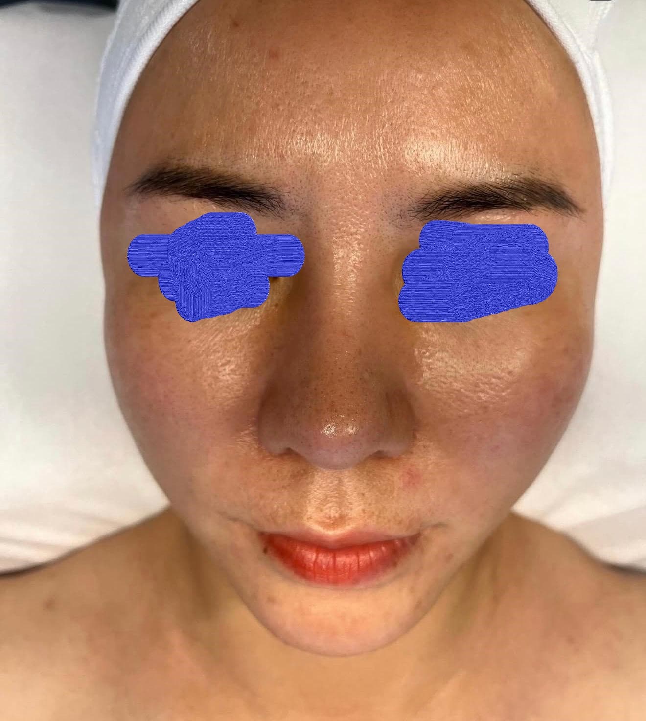 Client skin before professional esthetician treatment at Lumiderm Jacksonville FL