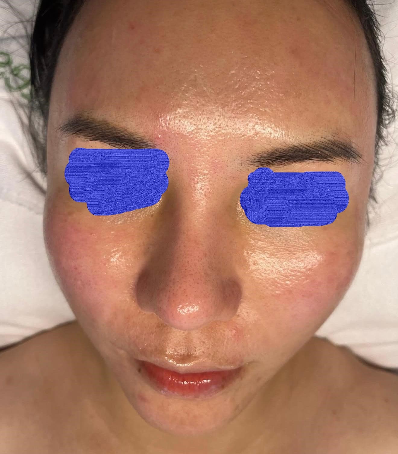 Client skin after professional esthetician treatment — healthier and more even complexion