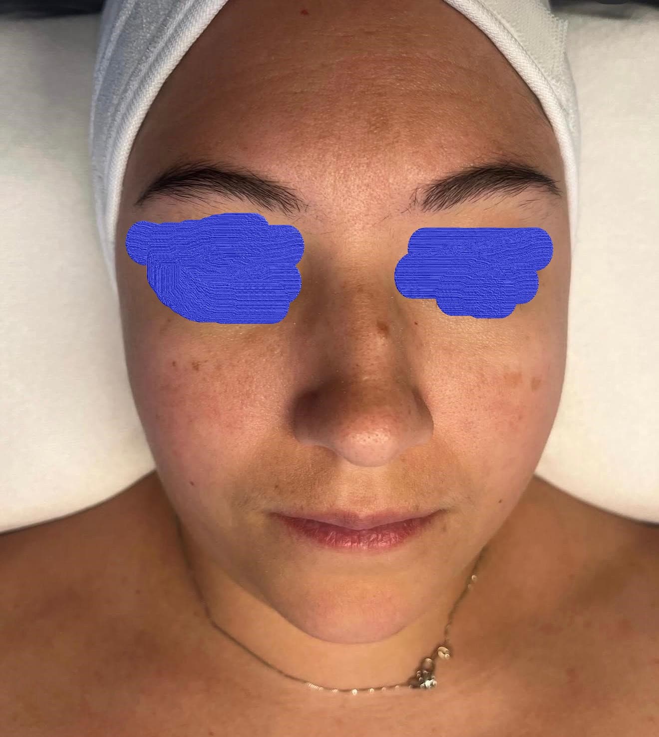Client skin before facial spa treatment at Lumiderm Jacksonville FL