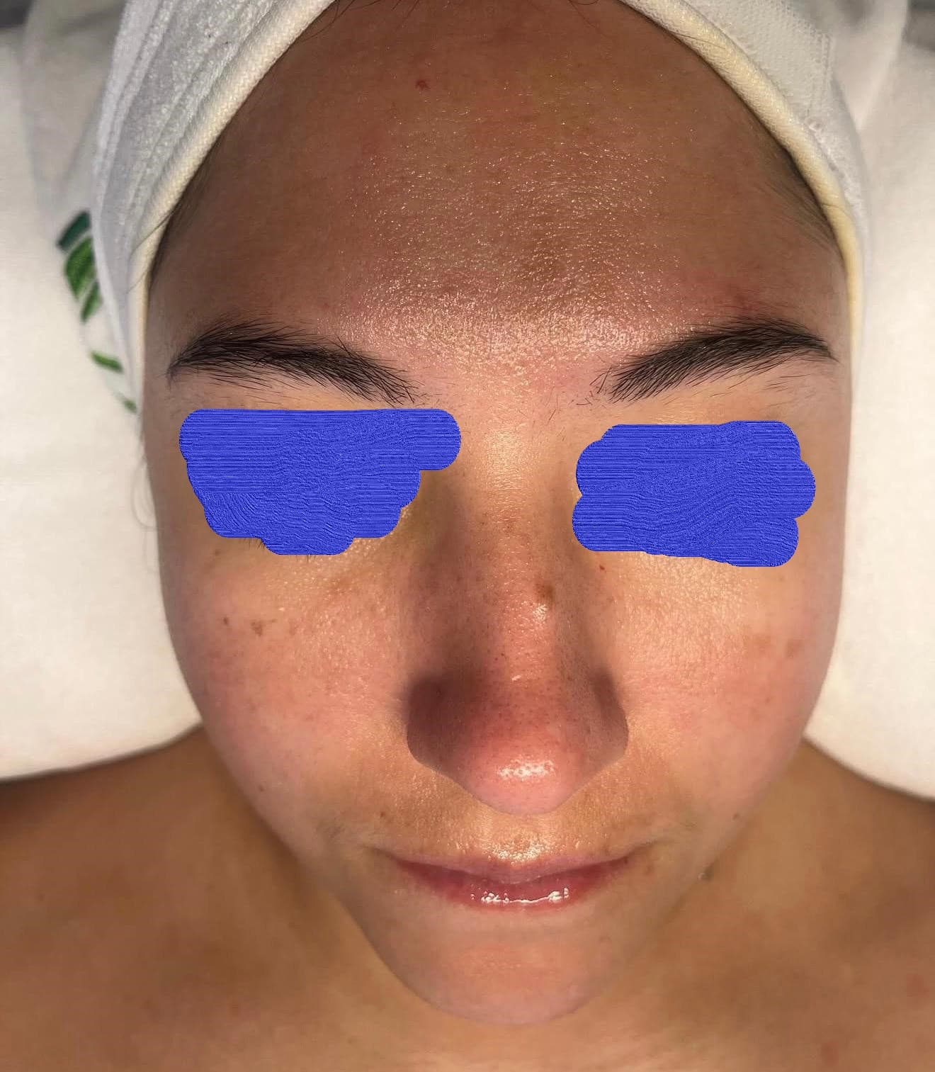 Client skin after facial spa treatment — visibly improved texture and glow
