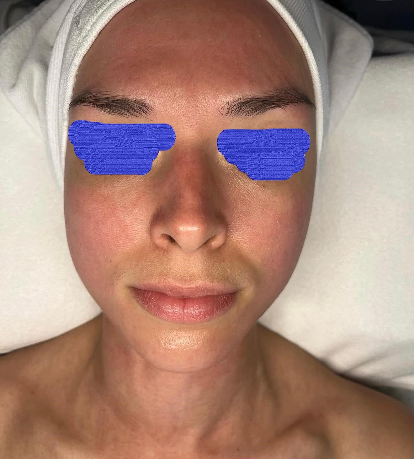 Client skin before personalised skincare treatment at Lumiderm Jacksonville FL