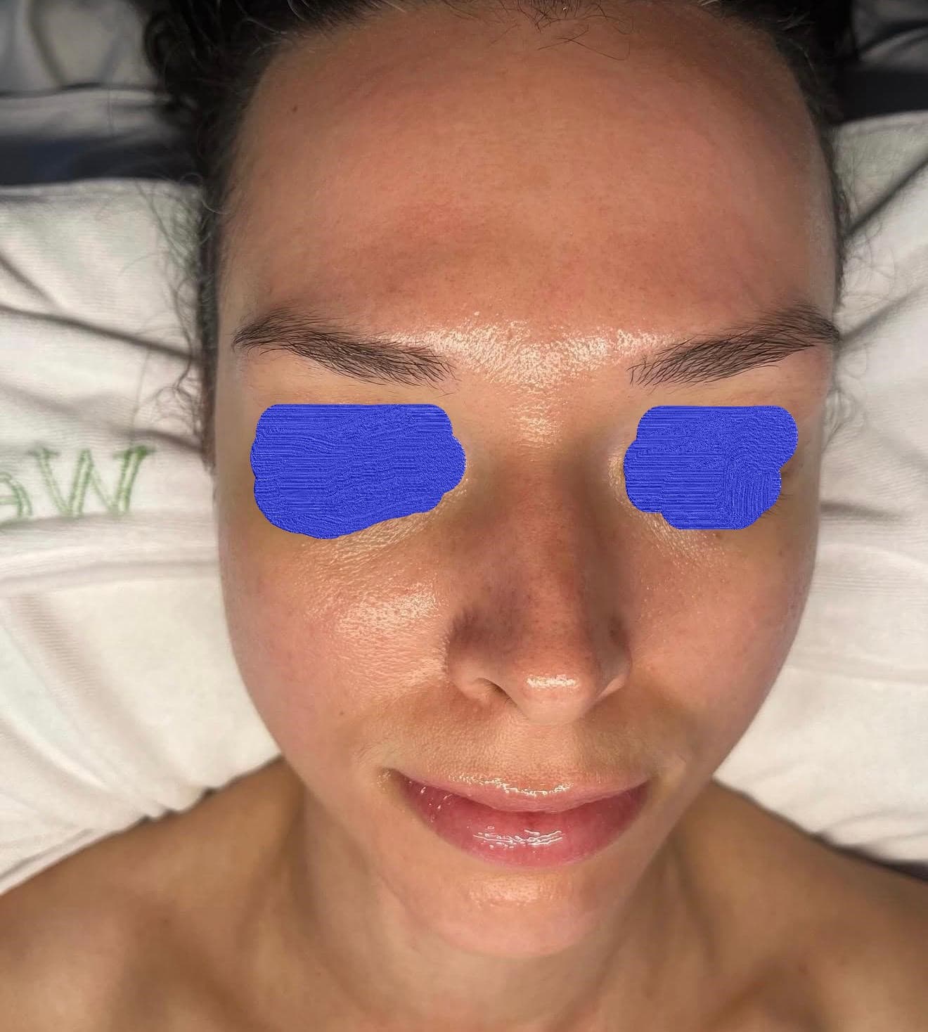 Client skin after personalised skincare treatment — transformed, radiant result